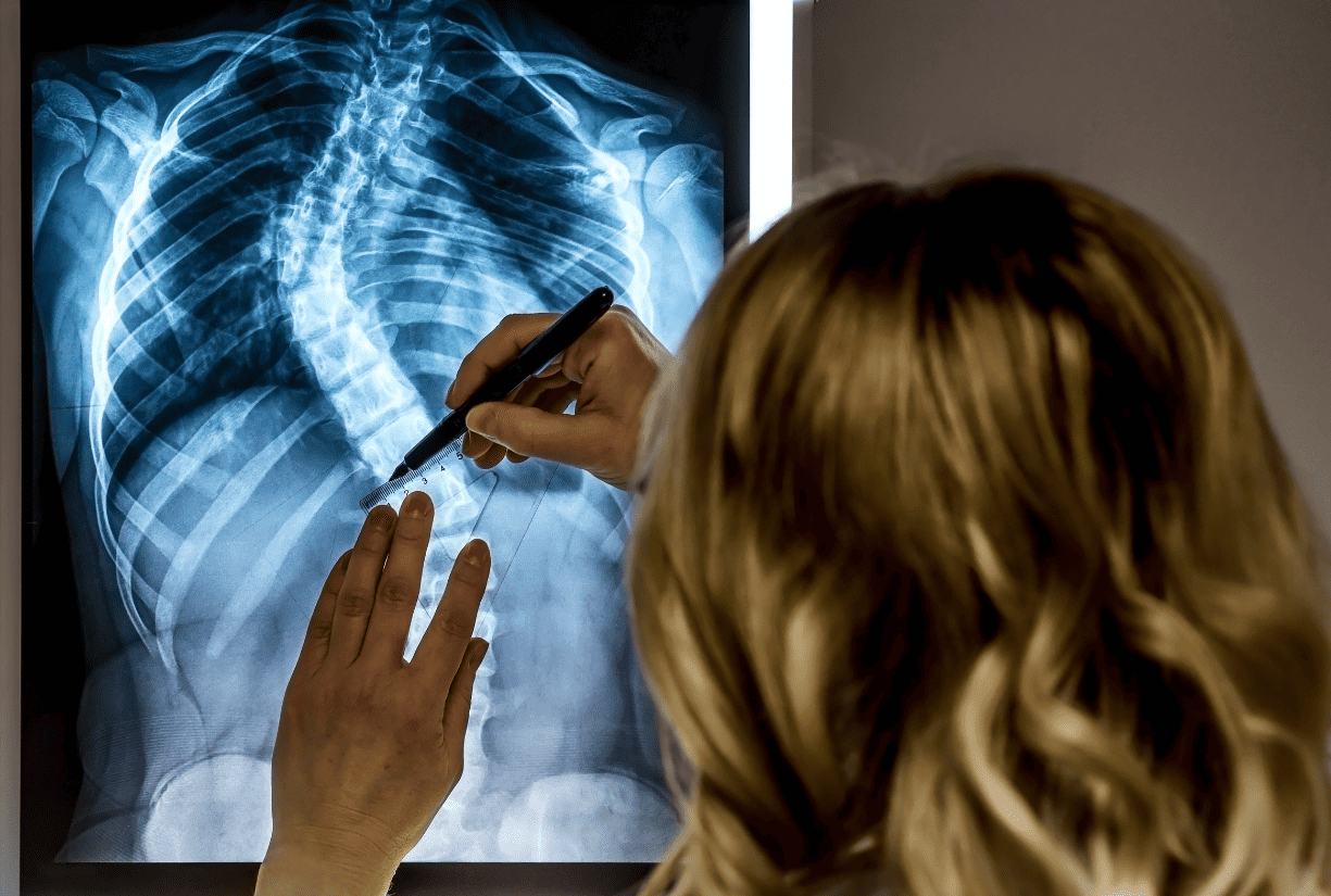 Female doctor inpexts x ray of twisted bent or spine with scoliosis 