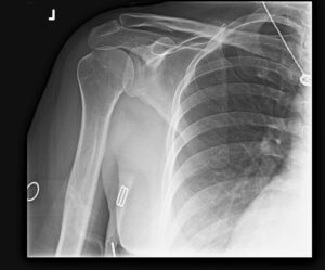 shoulder instability